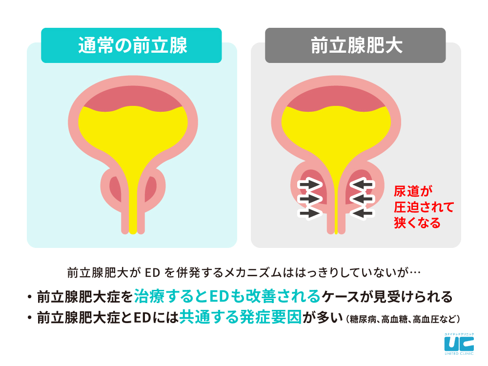 前立腺肥大症はEDを併発しやすい