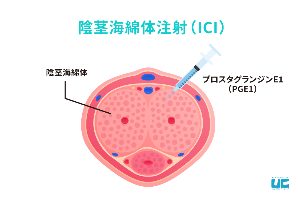 陰茎海綿体注射（ICI）
