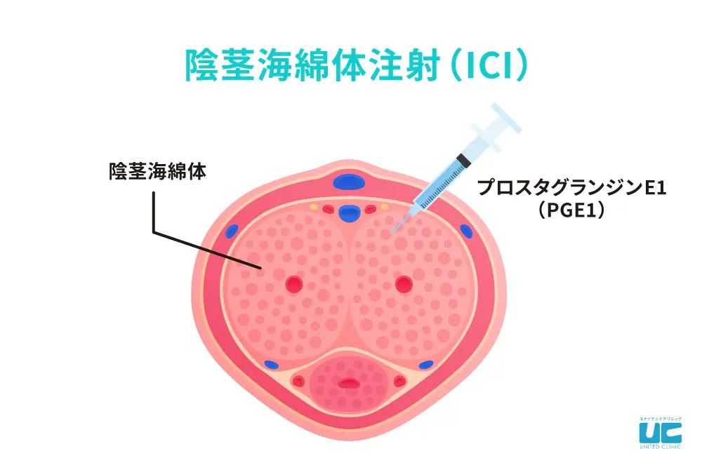 陰茎海綿体注射