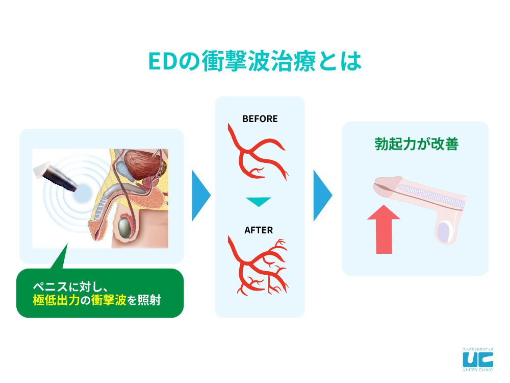 衝撃波治療