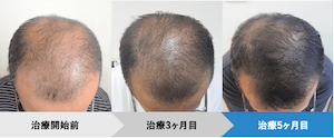 AGAヘアクリニック症例