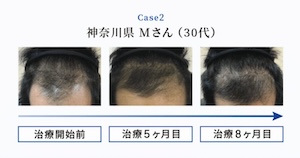 AGAスマクリ症例