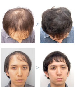 AGAスキンクリニック症例