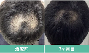 Dr.AGAクリニック症例