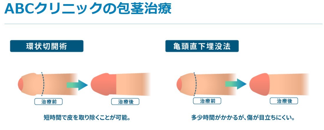 ABCクリニックの包茎治療