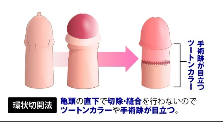 環状切開法の図解