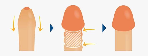 メンズライフクリニックの治療イメージ