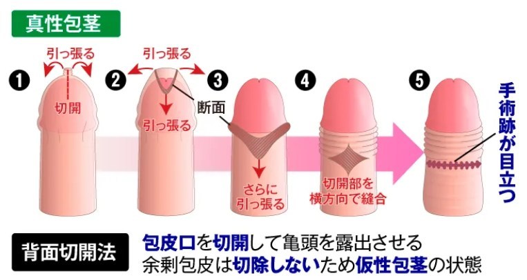 背面切開術の図解