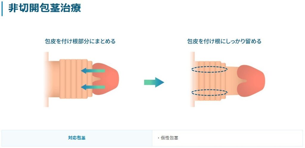 ABCクリニックの切らない包茎手術