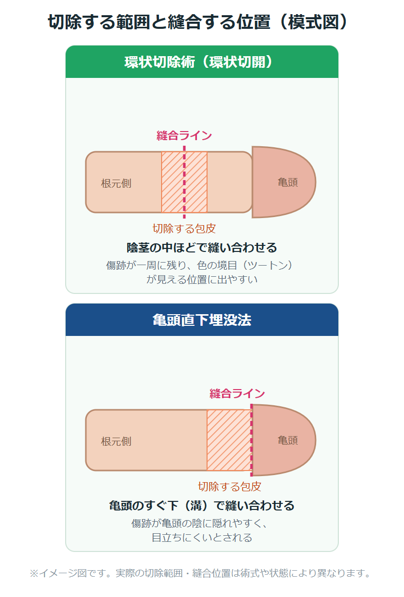 環状切除術と亀頭直下埋没法の切除範囲・縫合位置の模式図